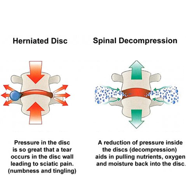 Benefits of Spinal Decompression Therapy