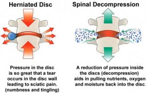 spinal-decompression